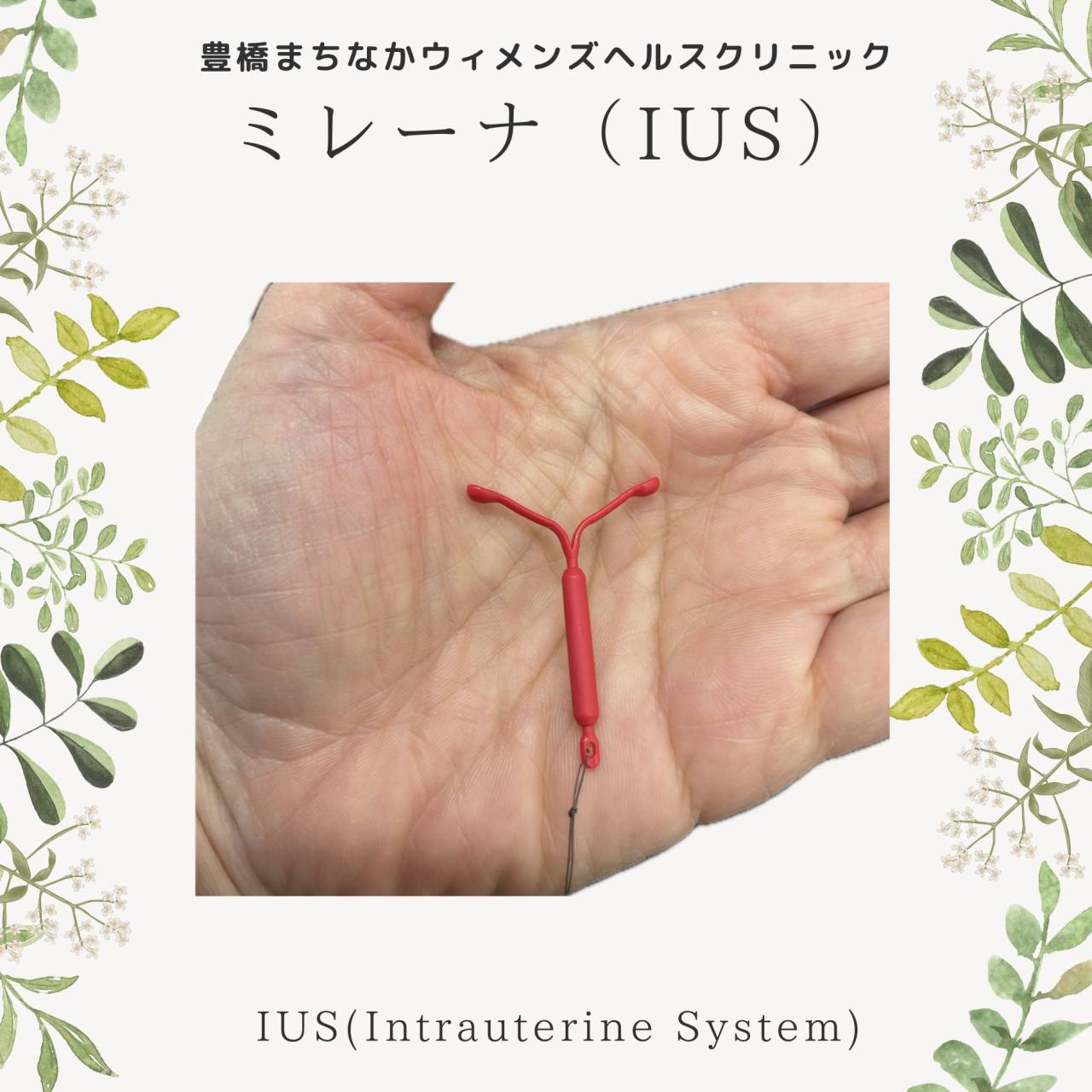 IUS(ミレーナ)について